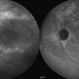 Cystoid Macular Edema (CME) Cystoid Macular Edema (CME)